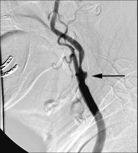 internal carotid narrowing with ulceation