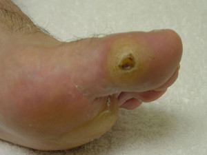 neuropathic toe ulcer