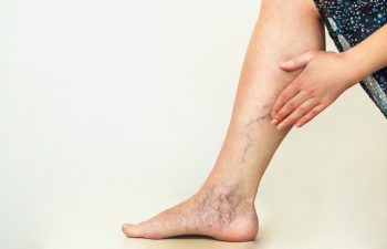 Varicose veins on the womans legs